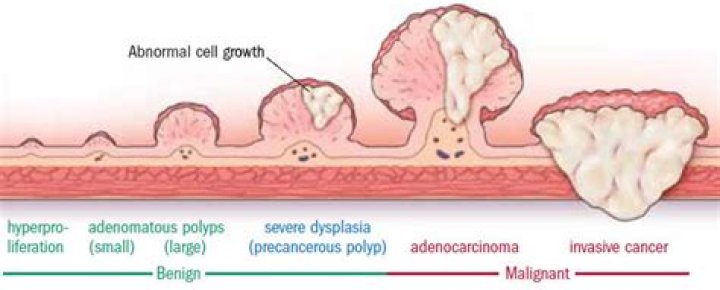 Are flat polyps always cancerous