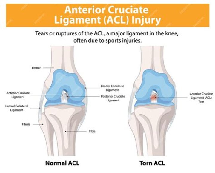 Can LCL heal without surgery