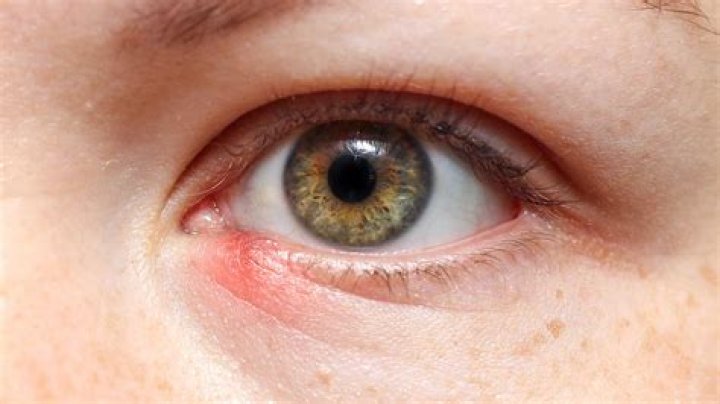 Can shingles start on eyelid