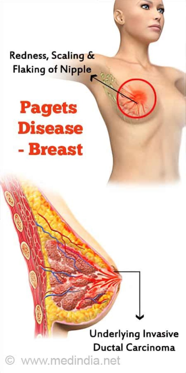 Can you die from Pagets disease of the breast