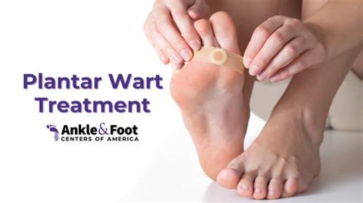 Can you surgically remove a plantar wart
