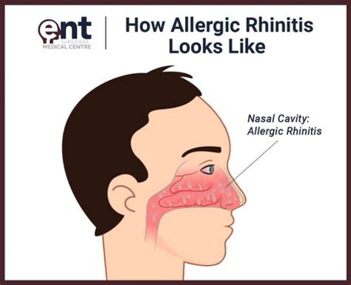 Does rhinitis go away on its own