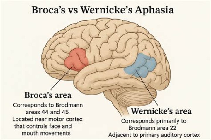 How do you treat Broca aphasia