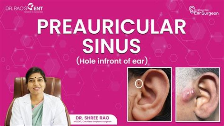 How do you treat Preauricular sinus infection
