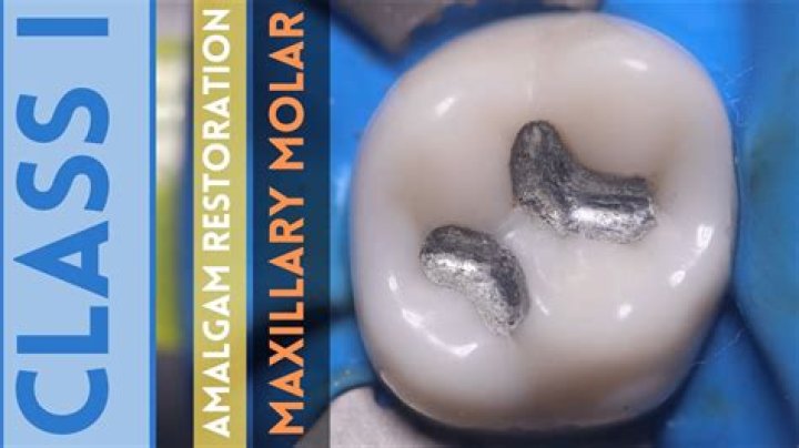 How does an amalgam differ from an alloy