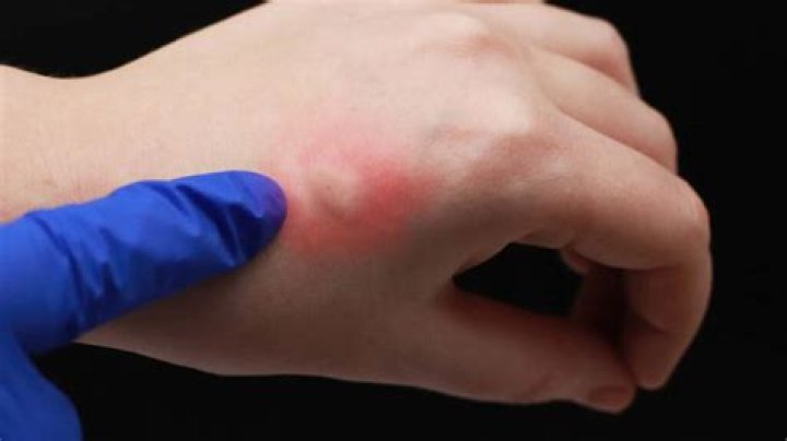 Is ammonia good for mosquito bites