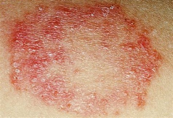 Is it eczema or fungal infection