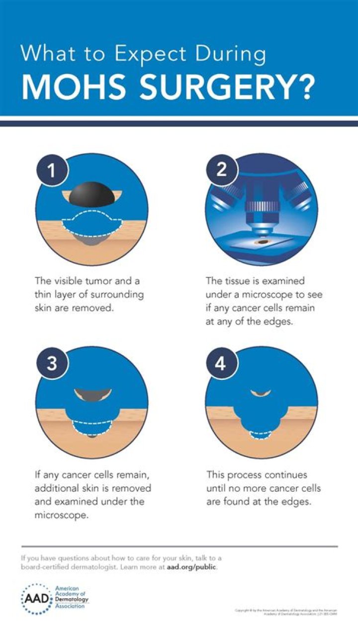 Is Mohs surgery always successful