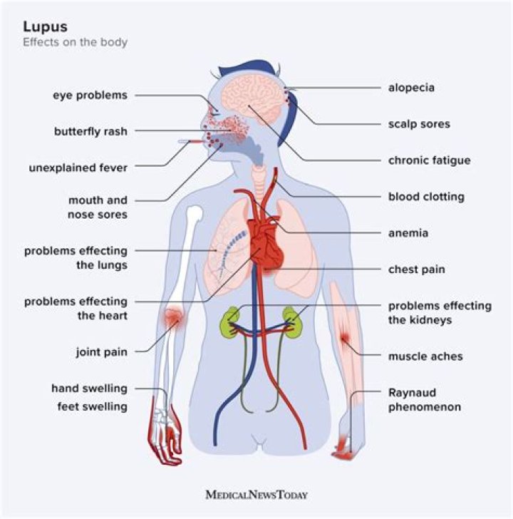 Is Numbness a symptom of lupus