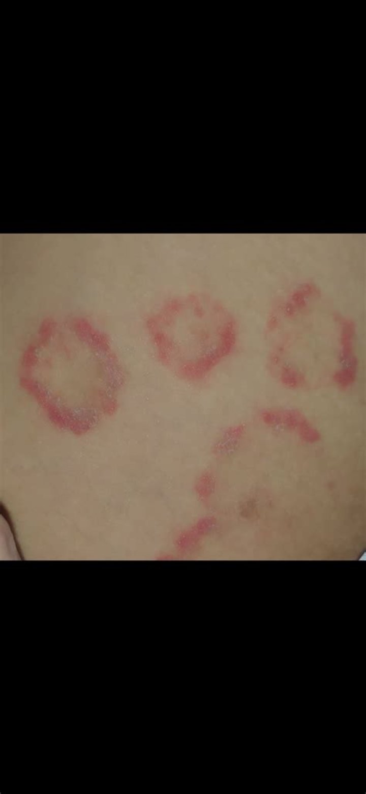 Is this ringworm or eczema