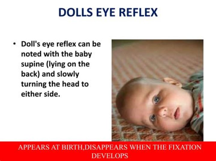 What causes dolls eye reflex
