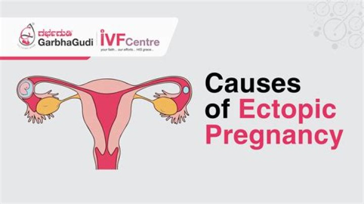 What causes ectopic focus