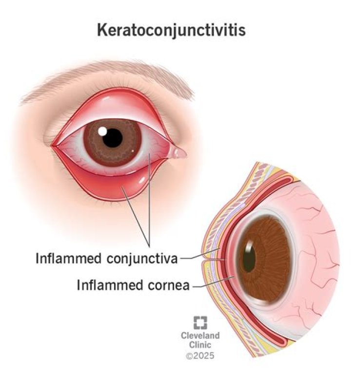 What causes epidemic keratoconjunctivitis