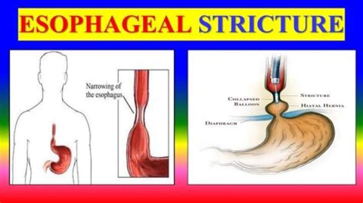 What causes esophageal webbing