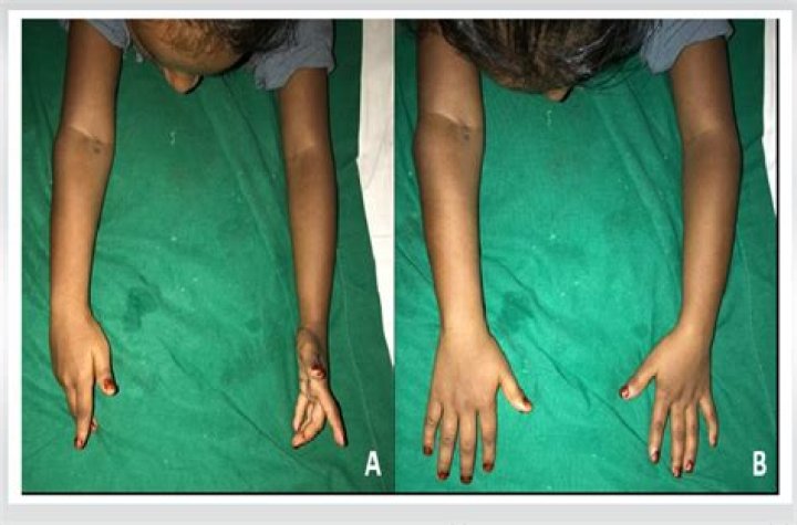 What causes Radioulnar Synostosis