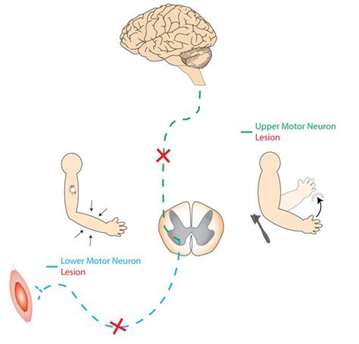 What causes upper motor neuron signs