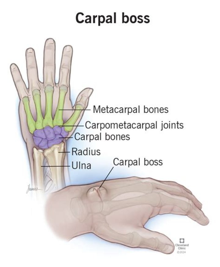 What does a broken carpal feel like