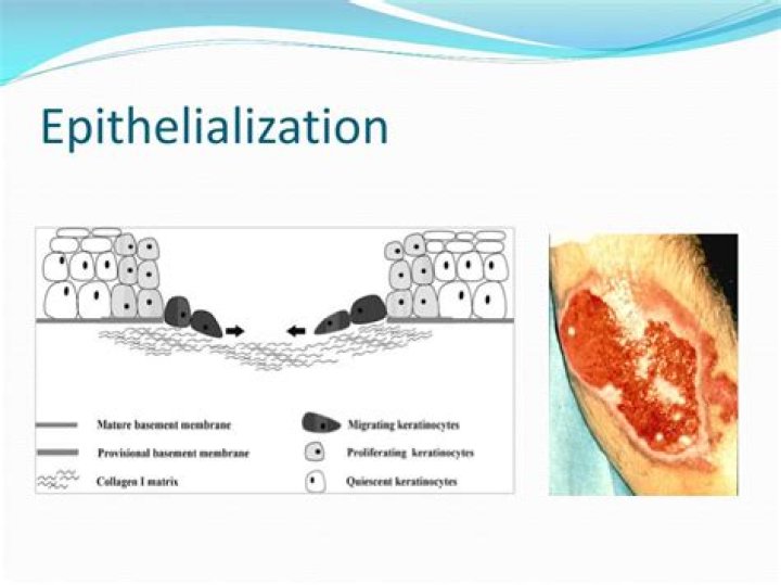 What does epithelialization mean