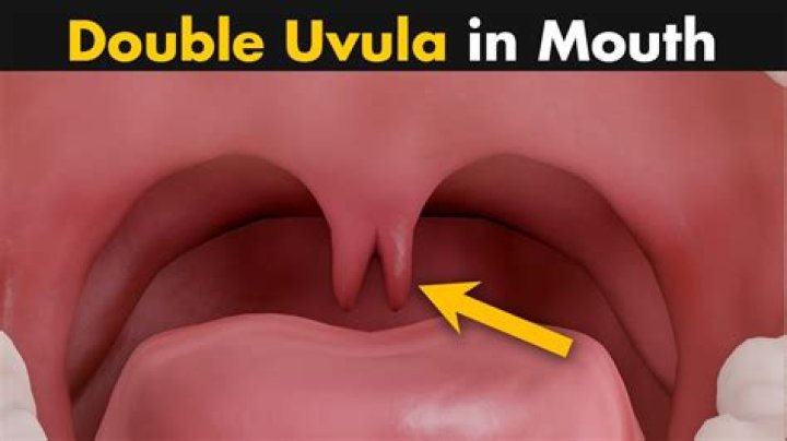 What does it mean to have a double uvula