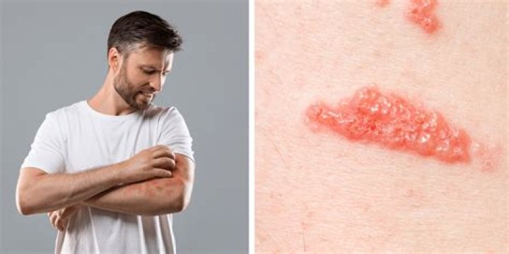 What does urushiol do to your skin