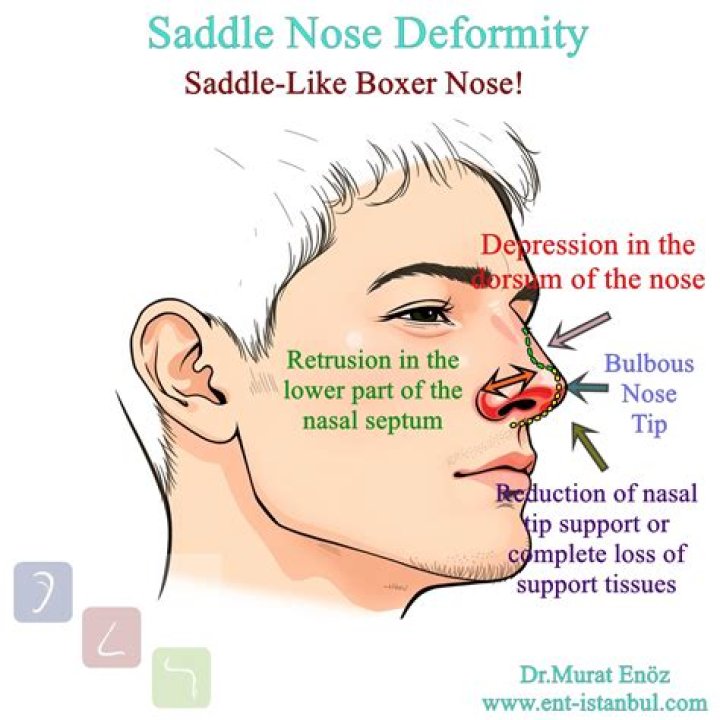 What is acquired deformity of nose