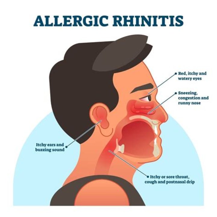 What is acute Rhinopharyngitis