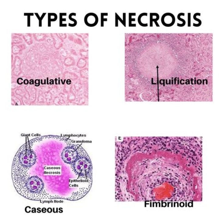What is Comedo type necrosis