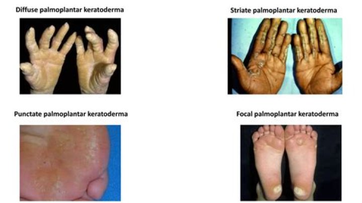 What is punctate Keratoderma
