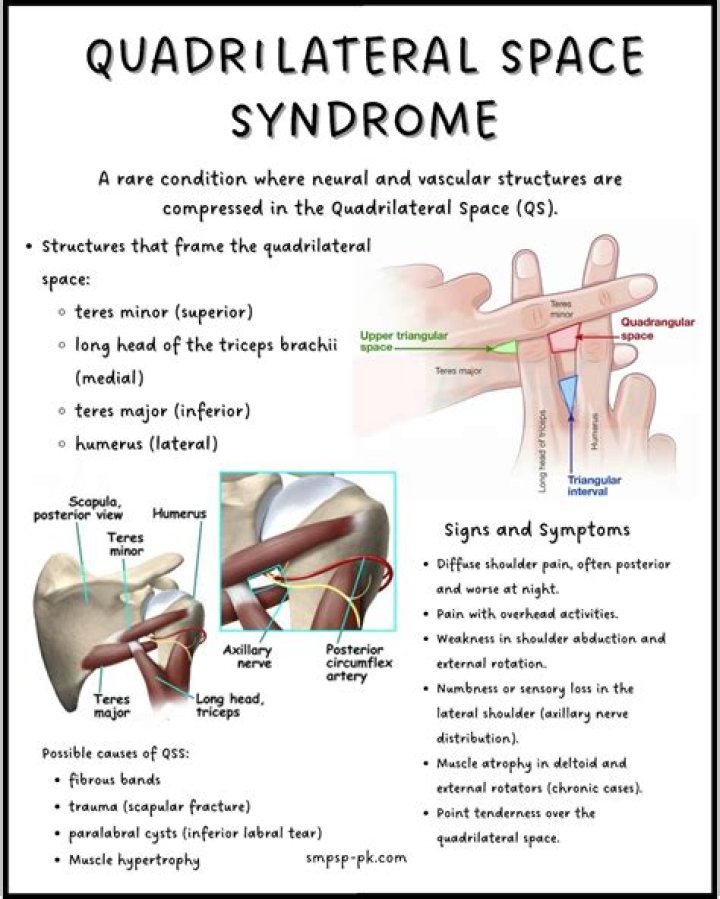 What is quadrilateral space syndrome