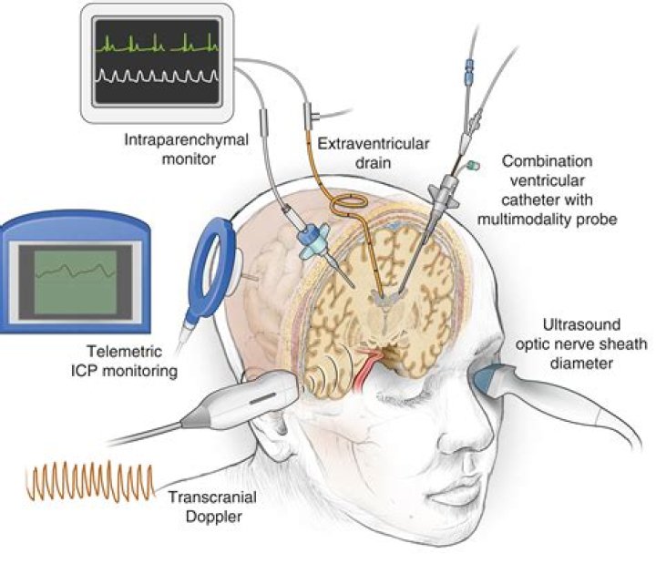 What is the gold standard for measuring intracranial pressure ICP
