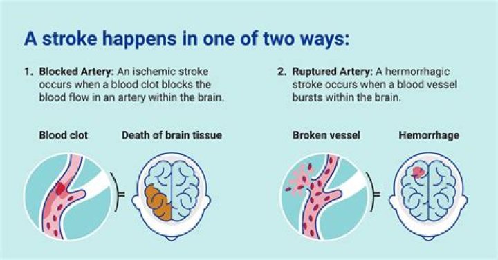 What is the most common cause of hemorrhagic stroke