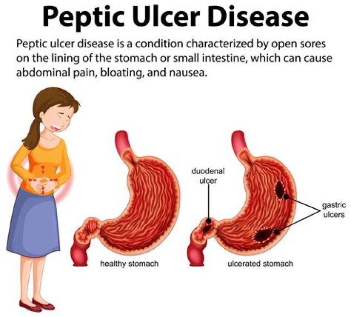 What is the most common cause of peptic ulcers quizlet