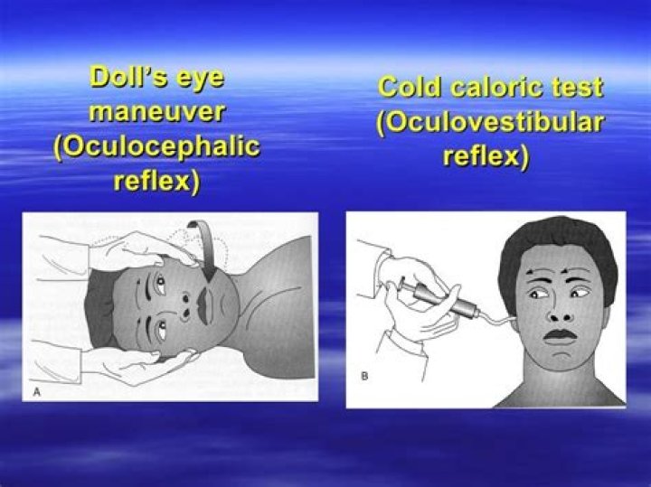 What is the Oculocephalic maneuver