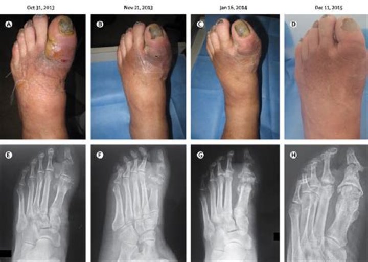What is used to treat osteomyelitis