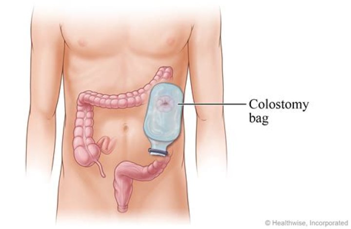 What not to eat if you have a colostomy bag