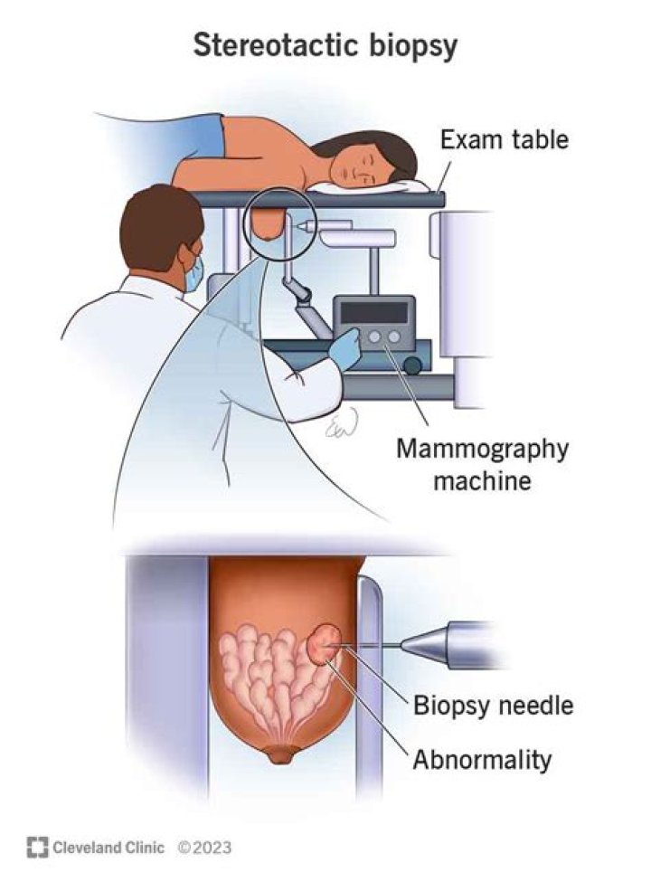 What percentage of stereotactic biopsies are benign