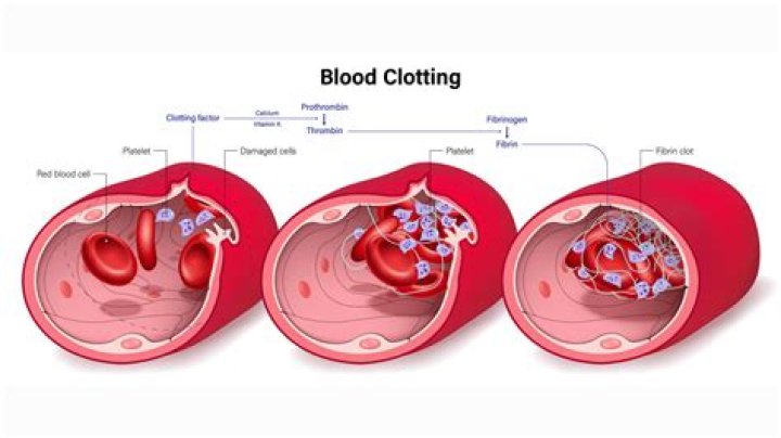 When a blood clot obstructs an artery in the lungs The condition is known as