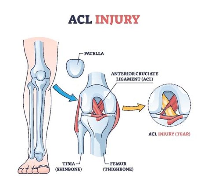 Where does the ACL originate and insert