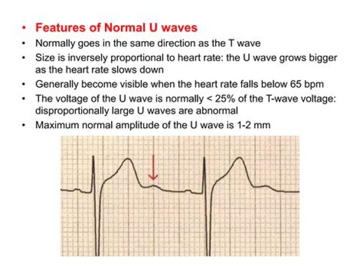Why is the baseline flat following the U wave